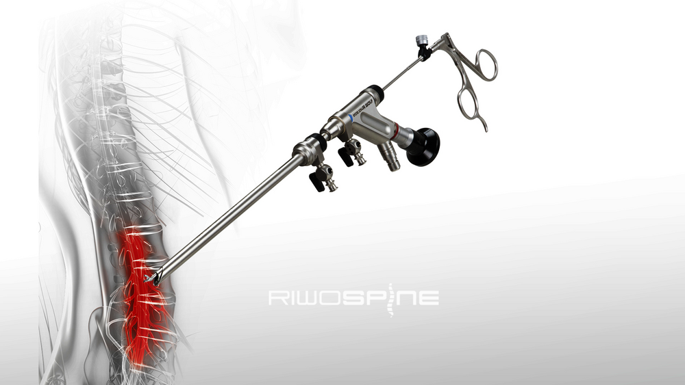 riwospine-vertebris-interlaminar-endoscopic-technique.png Endoscopic spinal decompression using VERTEBRIS interlaminar technique