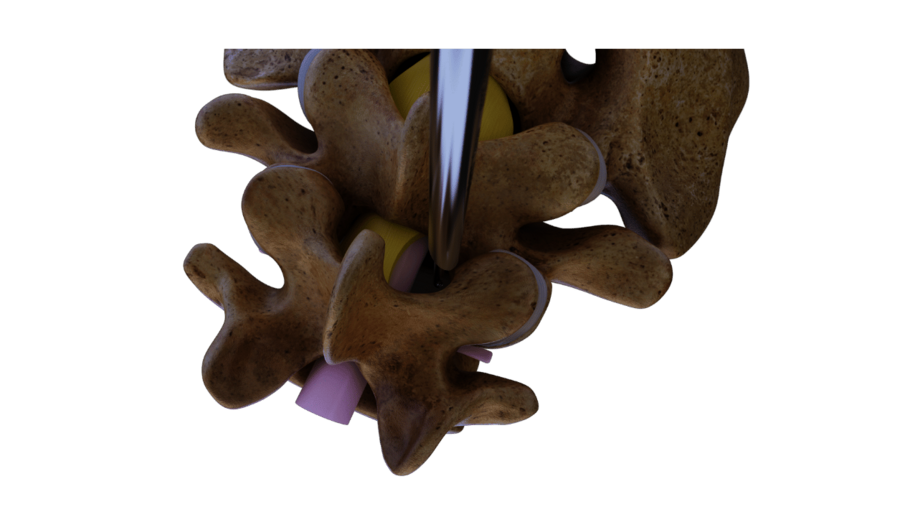 riwospine-superior-endoscopic-access-lumbar-stenosis.png Endoscopic access to lumbar spine from superior view for spinal stenosis decompression
