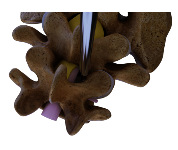 riwospine-superior-endoscopic-access-lumbar-stenosis.png Endoscopic access to lumbar spine from superior view for spinal stenosis decompression