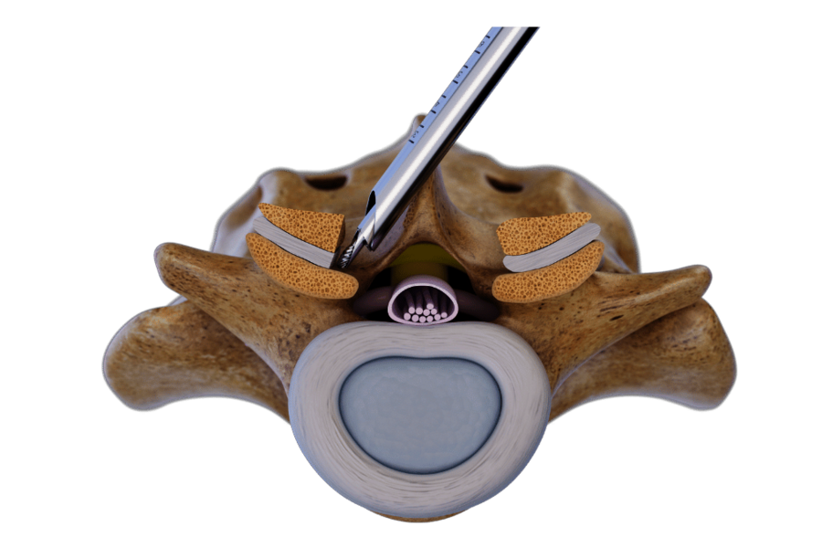 riwospine-over-the-top-contralateral-decompression-technique.png Over-the-top technique Contralateral decompression