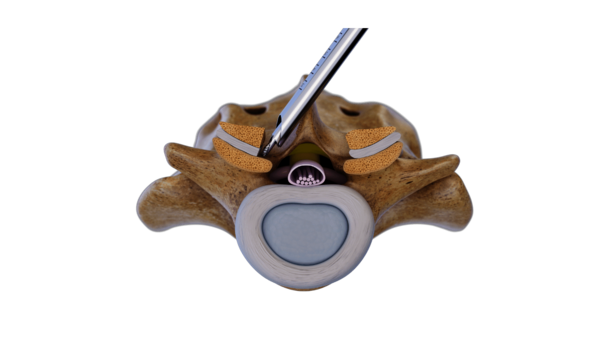 riwospine-over-the-top-contralateral-decompression-technique.png Over-the-top endoscopic technique for contralateral decompression in spinal stenosis