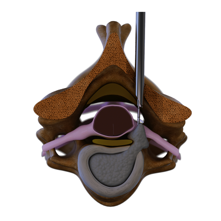 posterior-cervical-endoscopic-disc-removal-riwospine.png Spine cross-section graphic showing instrument treating disc herniation via posterior cervical technique