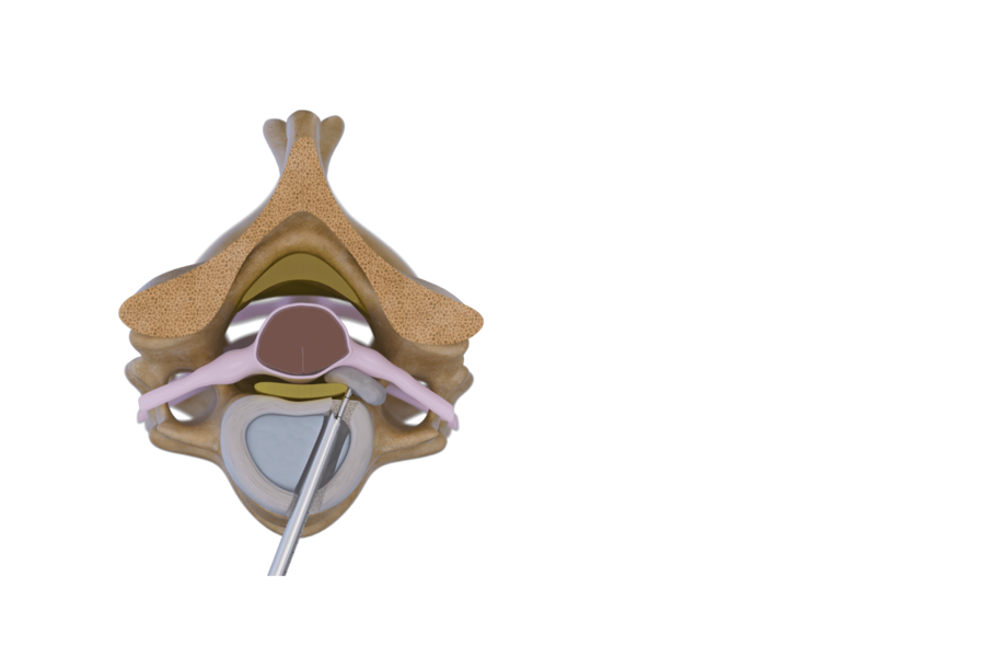 anterior-transdiscal-cervical-disc-removal-riwospine.png Spine cross-section graphic showing instrument treating disc herniation via transdiscal technique