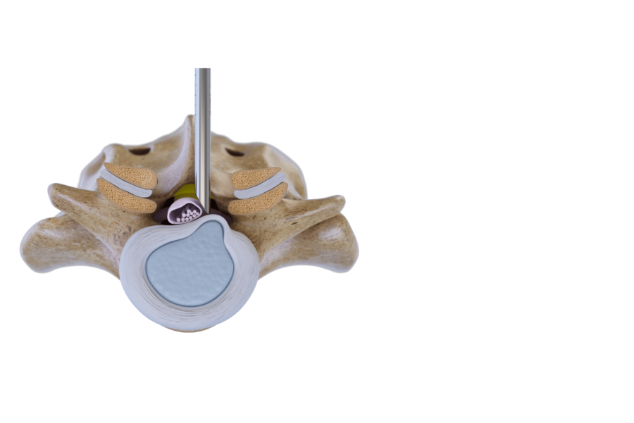 interlaminar-technique-endoscopic-lumbar-surgery-riwospine.png Spine cross-section graphic showing instrument treating disc herniation via interlaminar technique