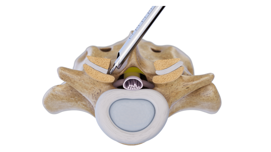 contralateral-decompression-over-the-top-riwospine.png 3D graphic of a spine and a RIWOspine instrument illustrating the over-the-top technique for contralateral decompression