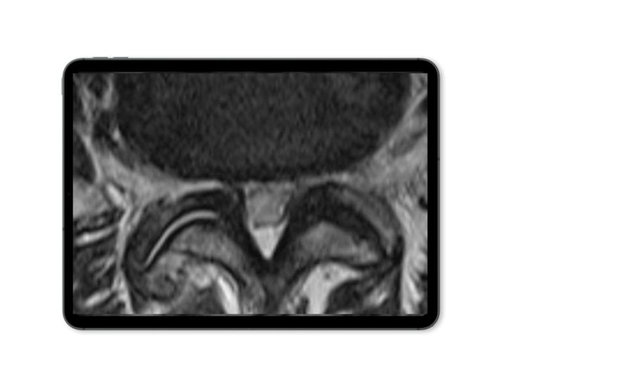 lateral-recess-stenosis-mri-riwospine.png Tablet mockup showing an X-ray image of lateral recess stenosis.