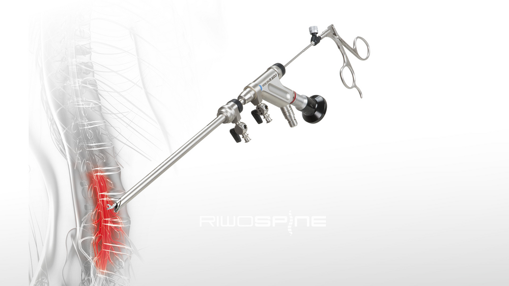 riwospine-vertebris-interlaminar-endoscopic-technique.png Endoscopic spinal decompression using VERTEBRIS interlaminar technique
