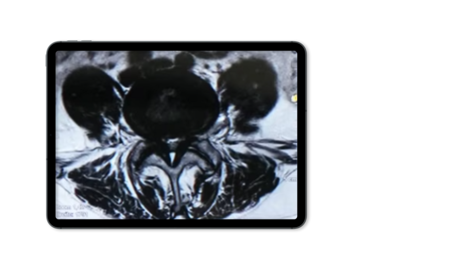 central-spinal-stenosis-mri-riwospine.png Tablet mockup showing an X-ray image of central stenosis.
