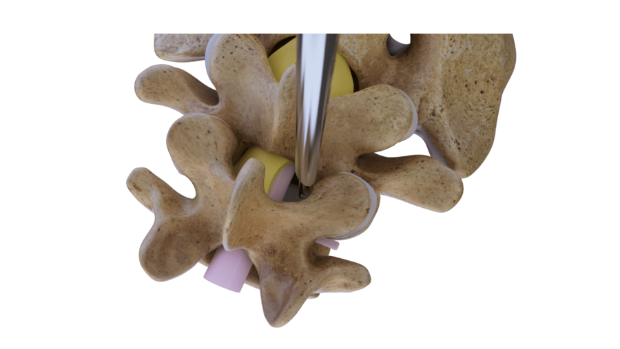 riwospine-superior-endoscopic-access-lumbar-stenosis.png Endoscopic access to lumbar spine from superior view for spinal stenosis decompression