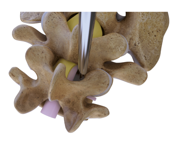riwospine-superior-endoscopic-access-lumbar-stenosis.png Endoscopic access to lumbar spine from superior view for spinal stenosis decompression