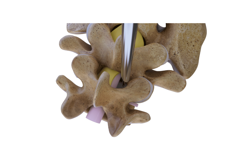 ipsilateral-decompression-spine-riwospine.png Three-dimensional rendering of an ipsilateral decompression procedure.
