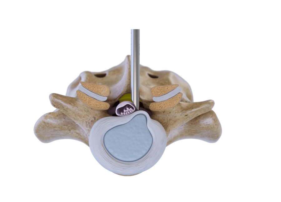 riwospine-posterior-cervical-technique-vertebris.png Posterior technique for cervical spine surgery with RIWOspine VERTEBRIS system