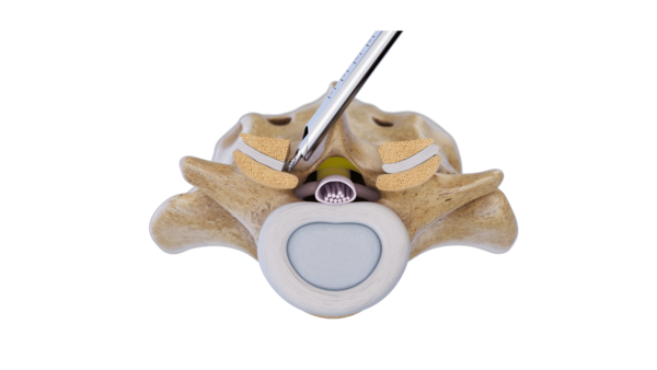 riwospine-over-the-top-contralateral-decompression-technique.png Over-the-top endoscopic technique for contralateral decompression in spinal stenosis