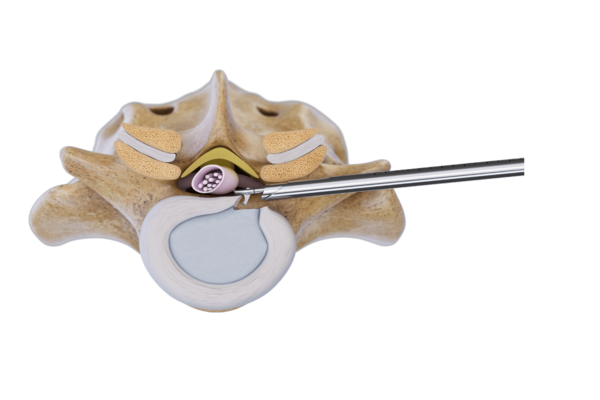 riwospine-vertebris-transforaminal-endoscopic-lumbar-access.png Transforaminal endoscopic access to lumbar spine with VERTEBRIS technique
