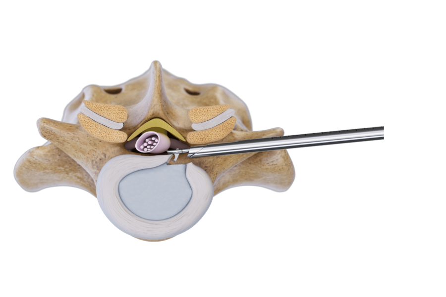 riwospine-vertebris-transforaminal-endoscopic-lumbar-access.png Transforaminal endoscopic access to lumbar spine with VERTEBRIS technique