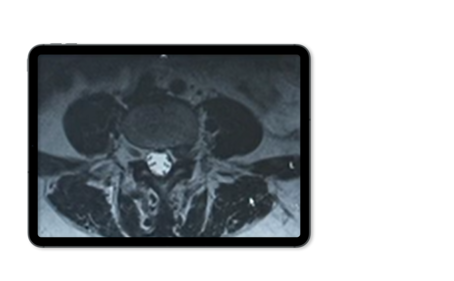 foraminal-stenosis-mri-riwospine.png Tablet mockup showing an X-ray image of foraminal stenosis.