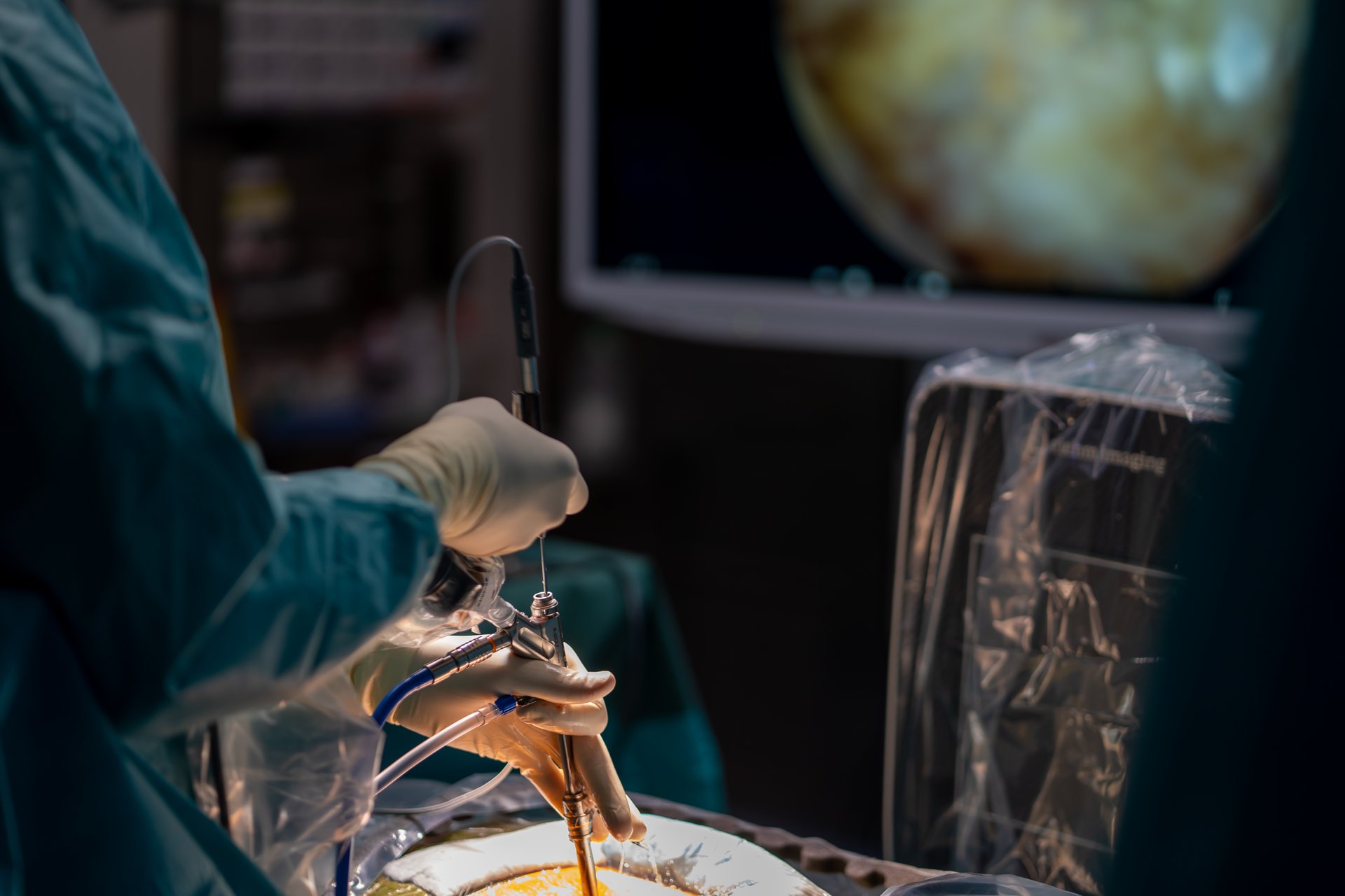 riwospine-insights-endoscopic-surgery-header.png Surgeon performing full-endoscopic spine surgery – RIWOspine clinical innovation and surgical insight