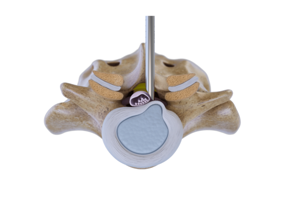 riwospine-vertebris-interlaminar-endoscopic-lumbar-surgery.png Endoscopic interlaminar access to lumbar spine using VERTEBRIS system