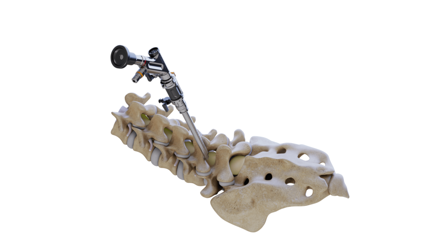 riwospine-endoscopic-lumbar-fusion-vertebris.png 3D graphic of a spine and a RIWOspine endoscope illustrating a minimally invasive lumbar interbody fusion procedure.