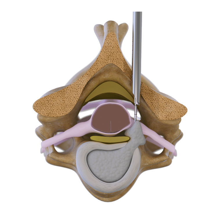 posterior-cervical-endoscopic-disc-removal-riwospine.png Spine cross-section graphic showing instrument treating disc herniation via posterior cervical technique